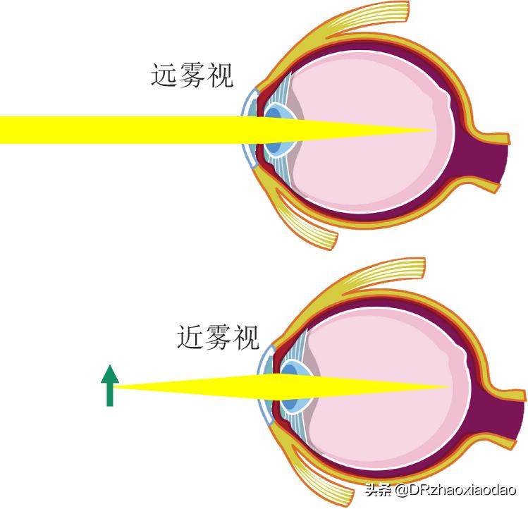 雾视治疗的最佳方法,雾视治疗是什么意思