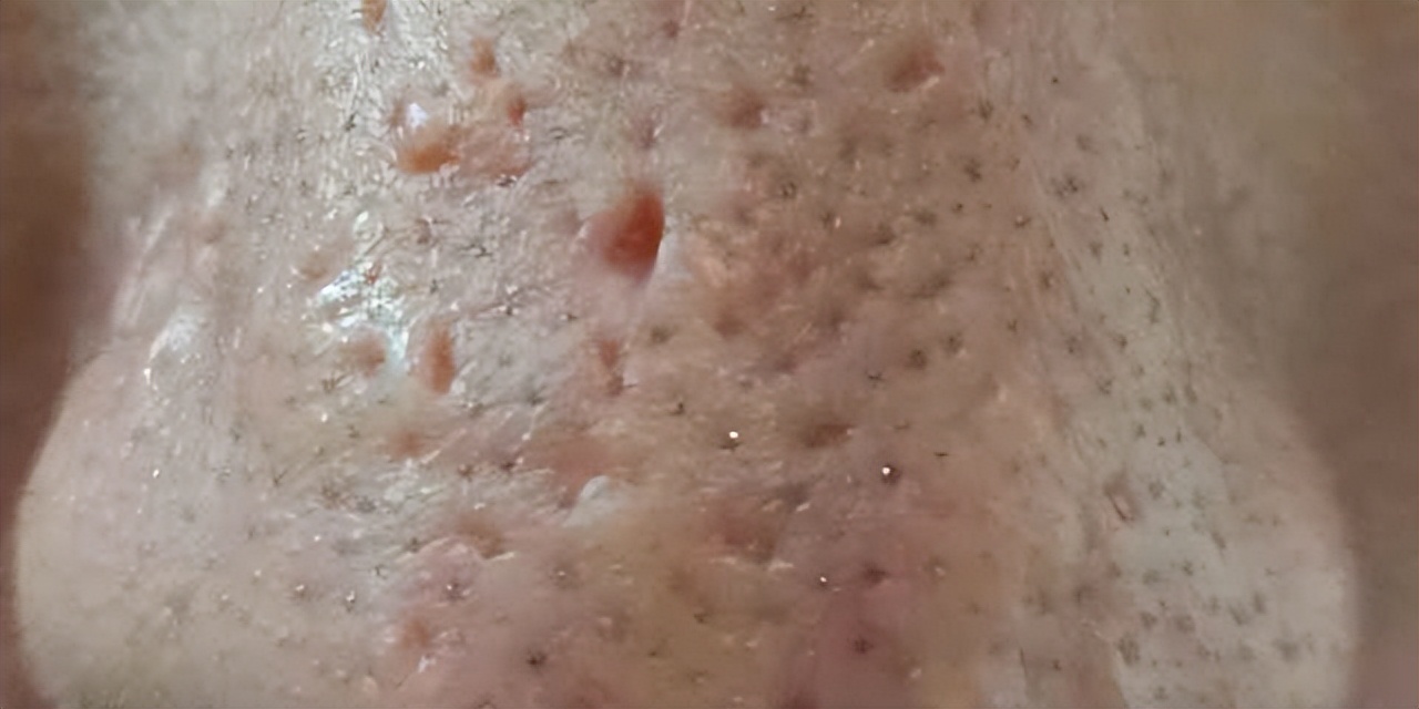 鼻子黑头挤出水一样的液体,鼻子挤黑头粉刺