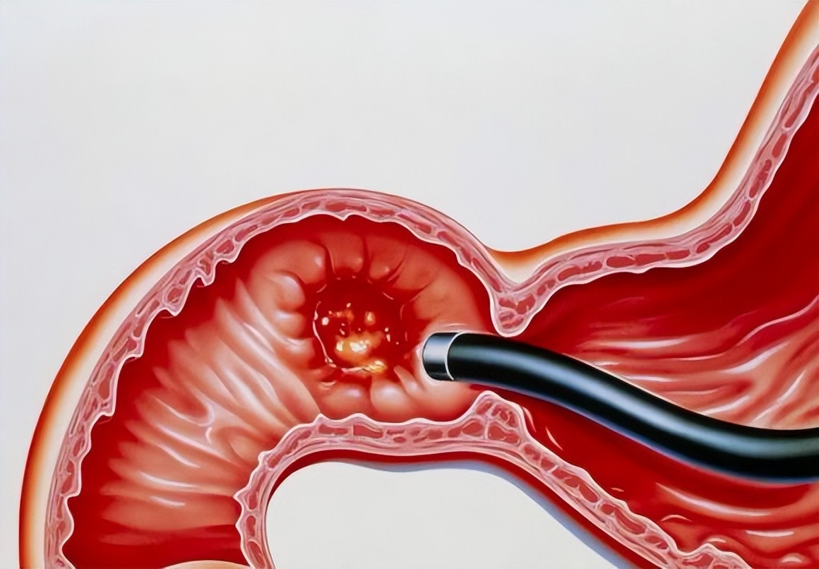 胃镜多久做一次不伤害胃,胃镜多久做一次好对胃有伤害吗