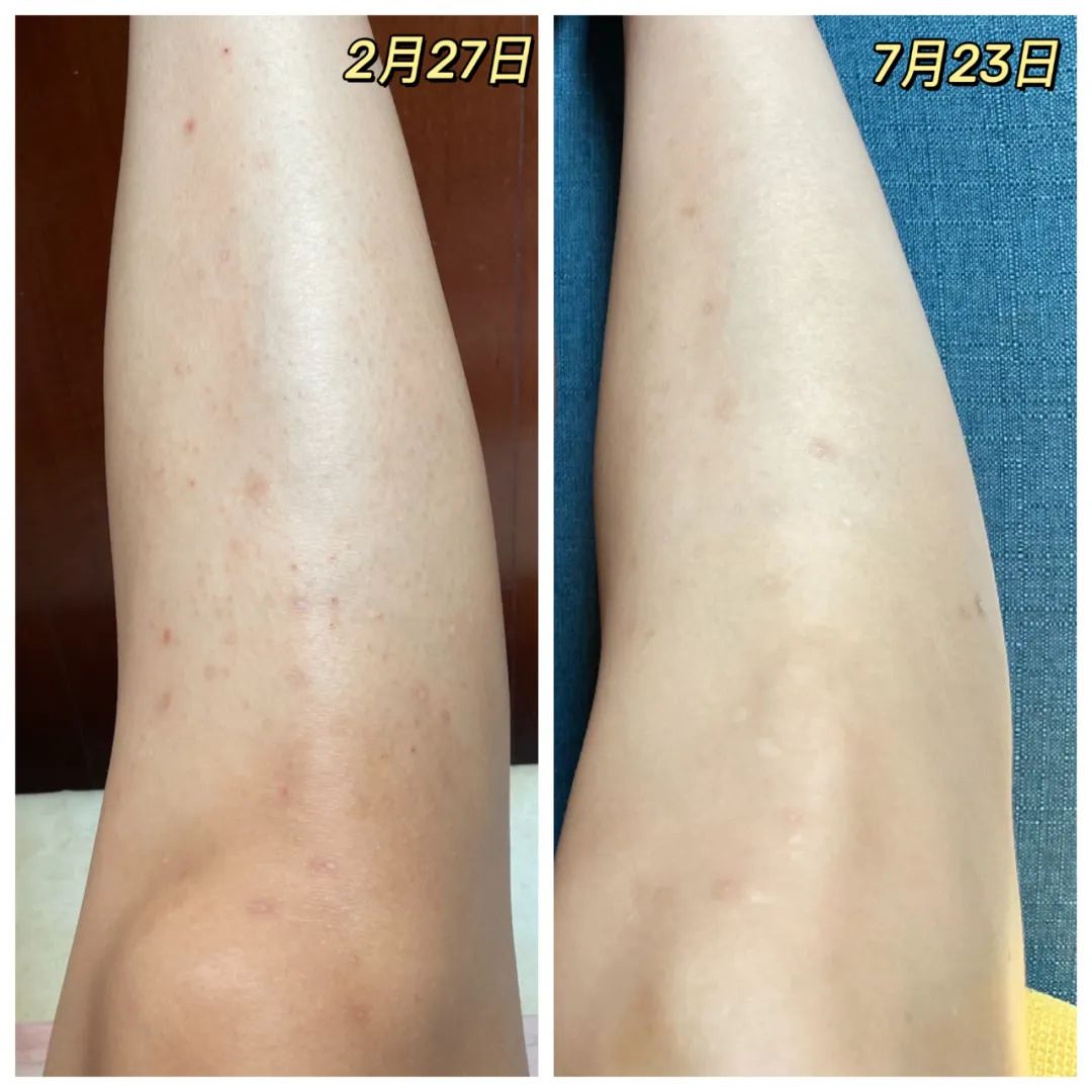 真实有效黑皮美白,针对天生黄黑皮美白一个月