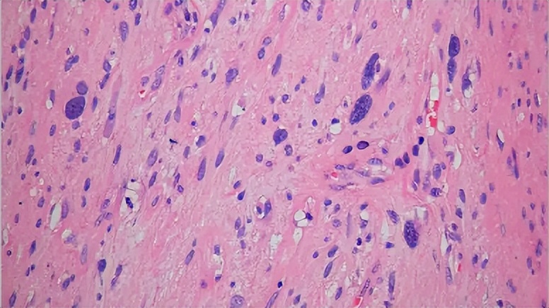 脂肪肉瘤和脂肪瘤摸着区别,脂肪瘤很常见吗