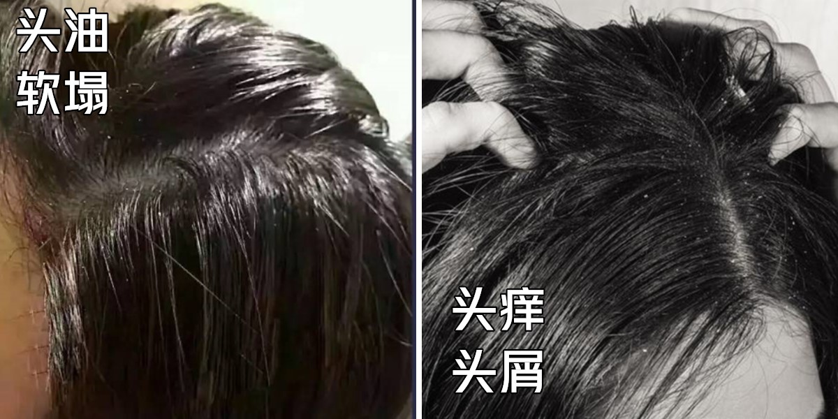 洗发水满婷去屑,洗发水白名单