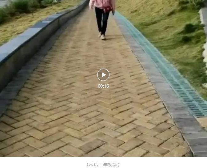 肌张力障碍植入脑起搏器有用吗,肌张力障碍脑起搏器手术费用