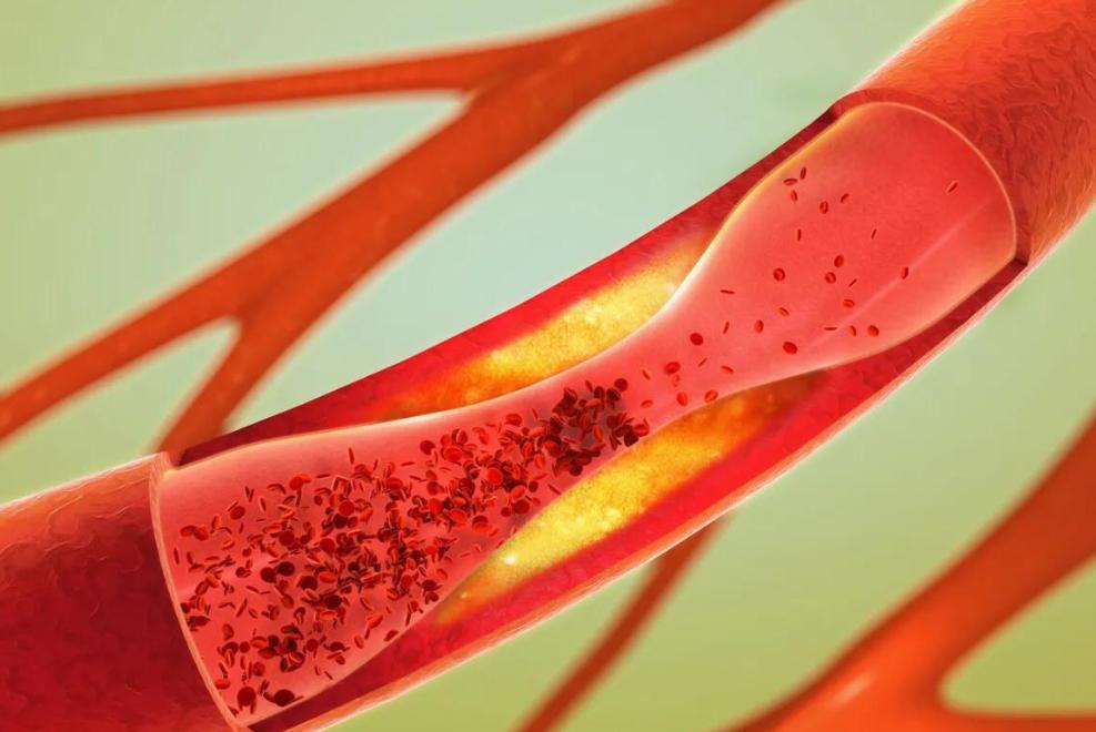 脑梗吃什么中成药可预防脑梗复发,中老年如何预防脑梗心血管疾病