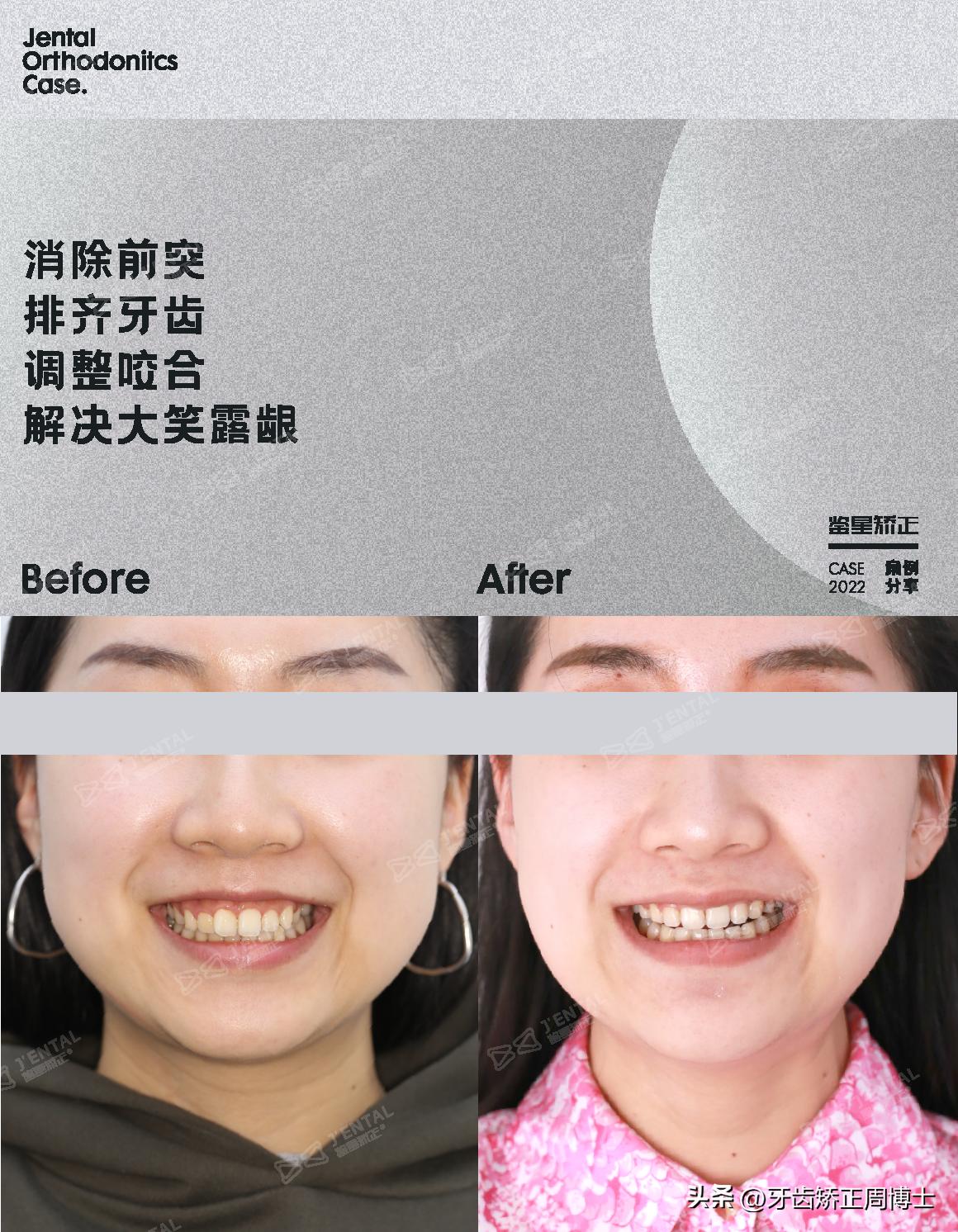 即刻种植即刻修复免受缺牙的痛苦,缺牙不补倾斜矫正价钱