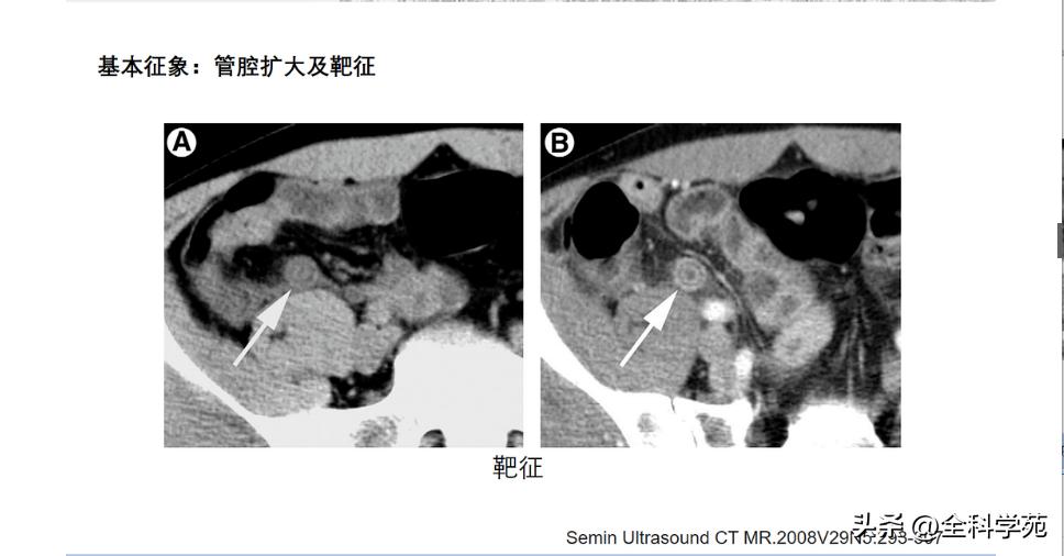 阑尾炎的讲解,关于阑尾炎的讨论总结