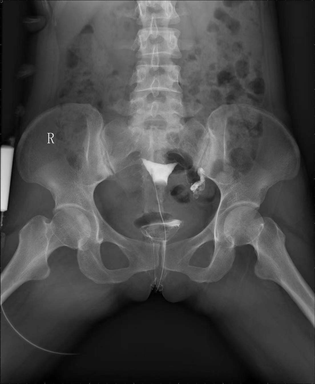 粤桂协作：罗城仫佬族自治县人民医院开展首例门诊医生协作输卵管造影术