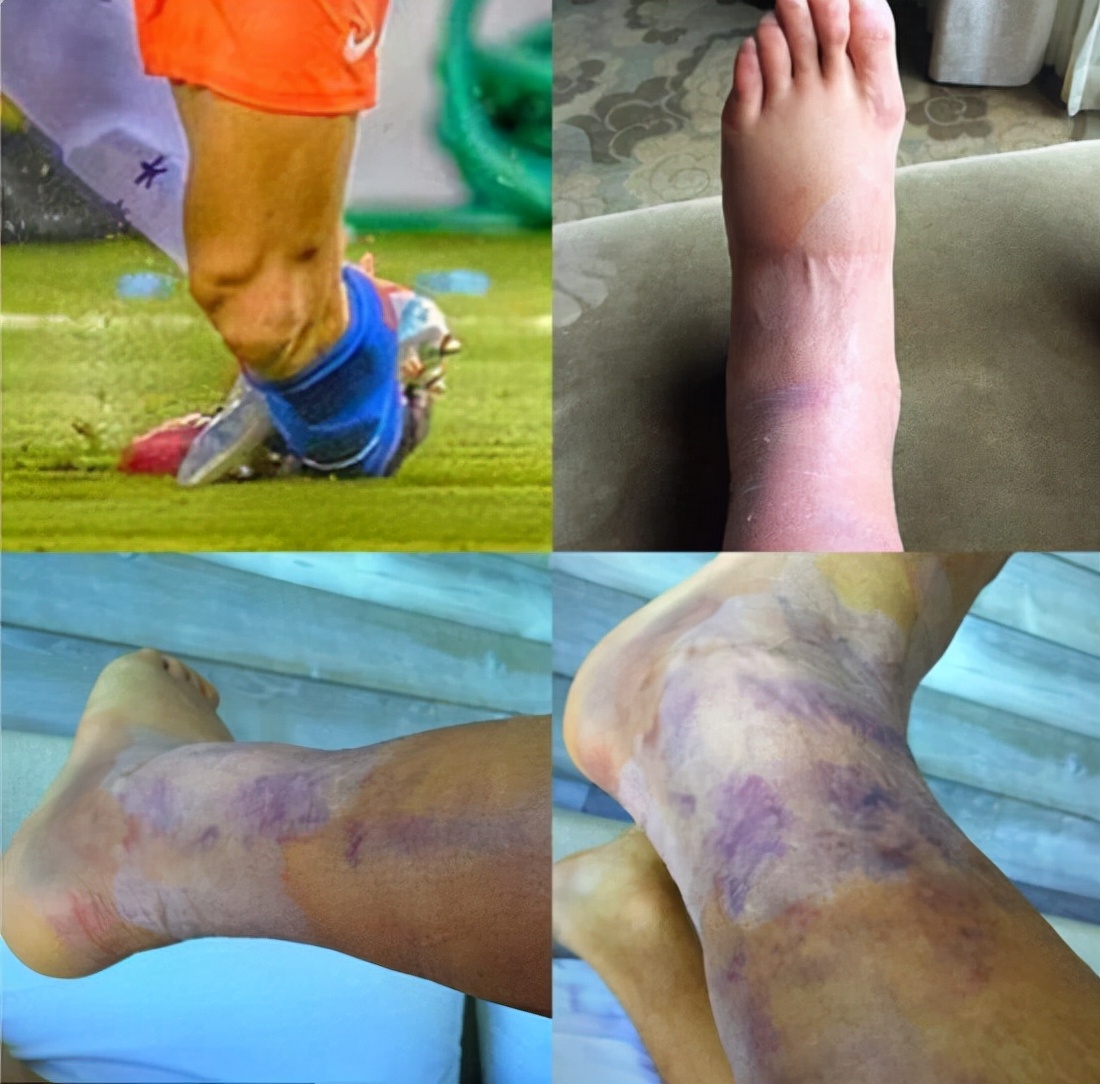 内马尔脚踝变形落泪被担架抬走,内马尔脚受伤