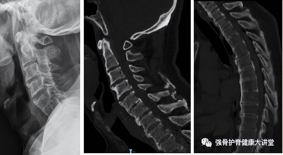 强直性脊柱炎有骨折怎样治疗,强直性脊柱炎容易误诊吗