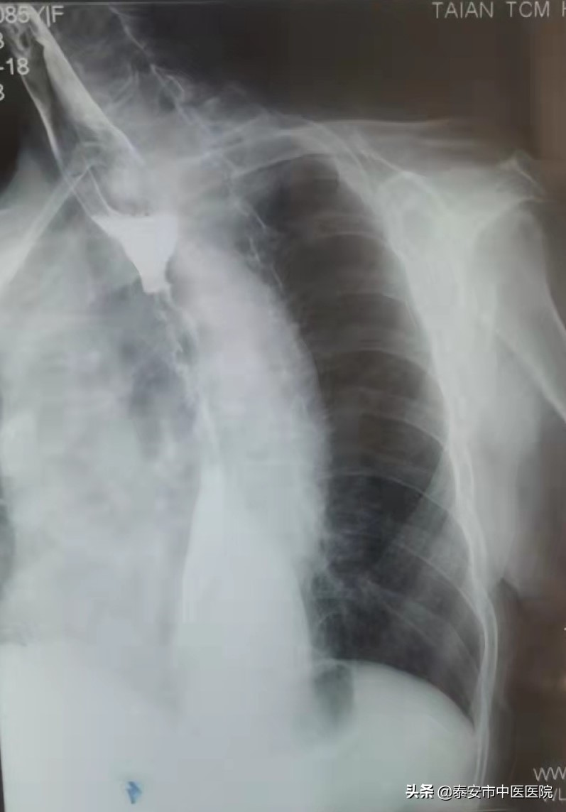 食管癌中段内镜下消融术,食管癌早期内镜下消融术