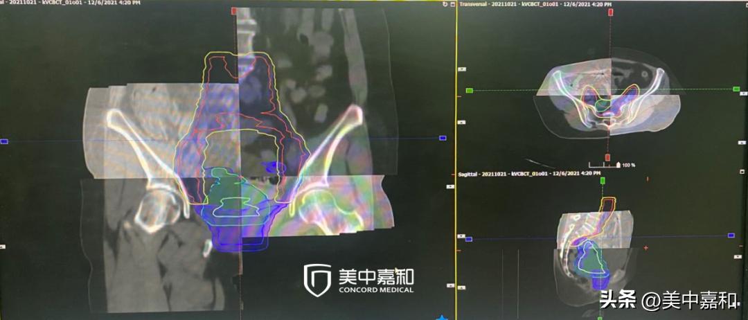 局部癌症,癌症晚期的奇迹案例