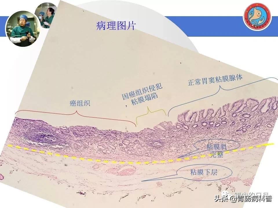 胃癌可以做内镜手术吗,早期胃癌内镜手术后追加外科手术