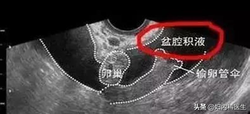 盆腔积液达到多少才需要治疗,女性盆腔积液腹痛用什么药最好