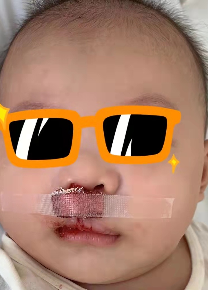 宝宝是一只“小兔子”，还没长牙就要开始正畸了