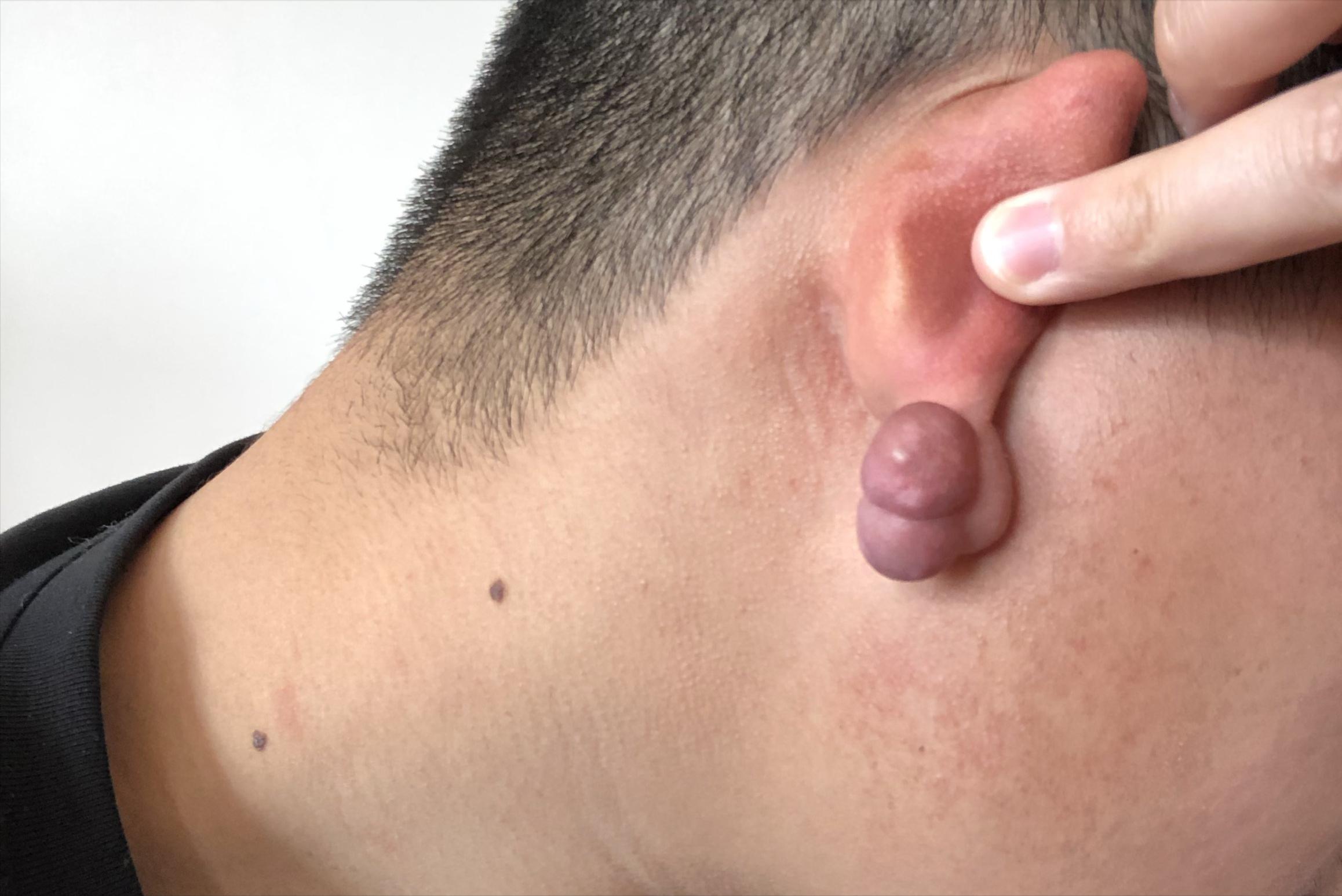 痘痘引起的瘢痕疙瘩怎么治疗,下巴痘痘变成硬疙瘩消除无疤痕