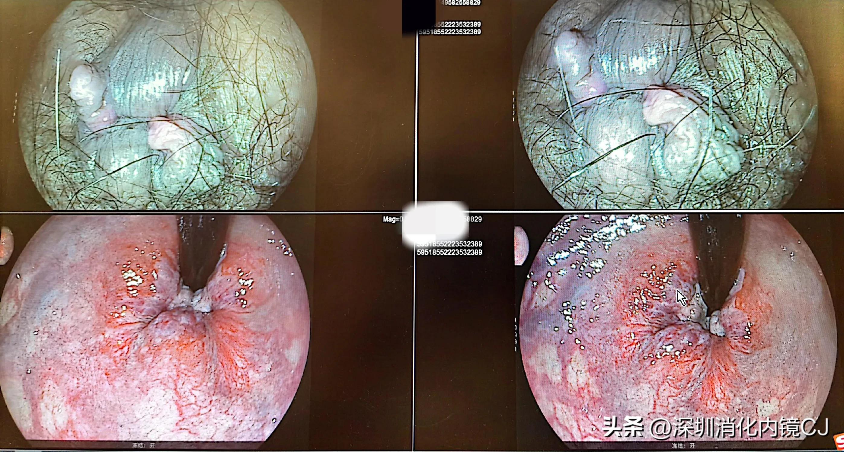 iii型痔疮,哪些痔疮患者适合内镜下套扎治疗