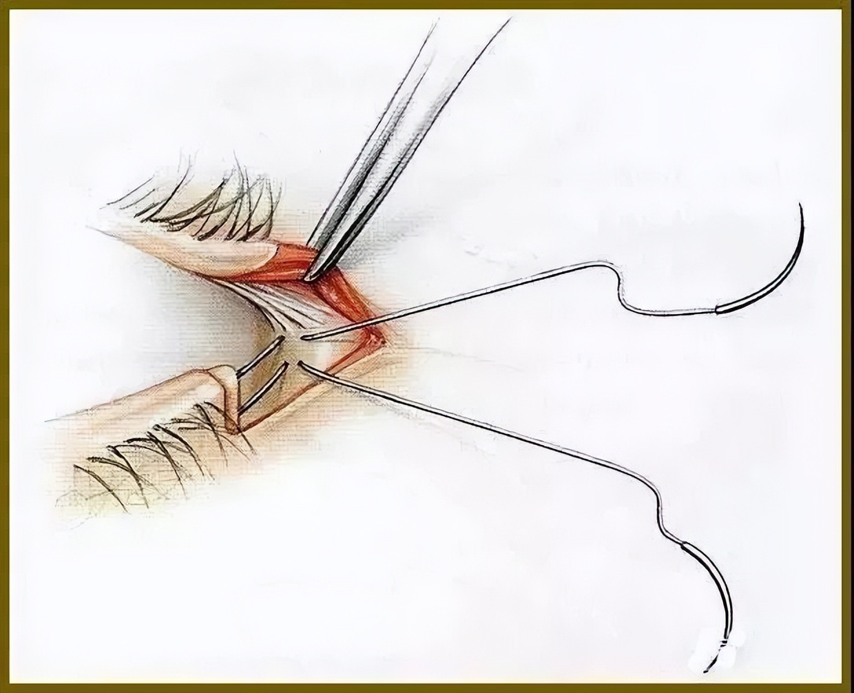 目前有效的除皱方法,有几种长久有效的除皱方法