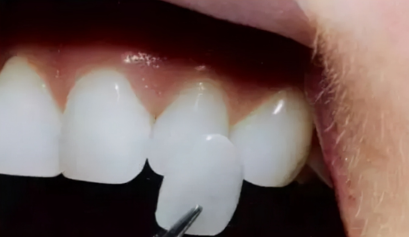 烤瓷牙的缺点危害亲身经历,烤瓷牙各有哪些优缺点