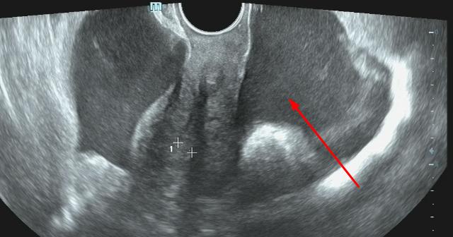 b超能查出盆腔肿瘤吗,B超能查出盆腔炎症吗