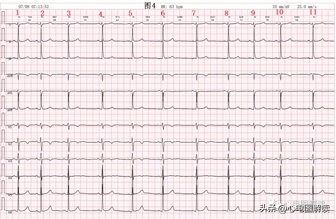窦房结游走心律的临床意义,窦房结游走心律心电图特征