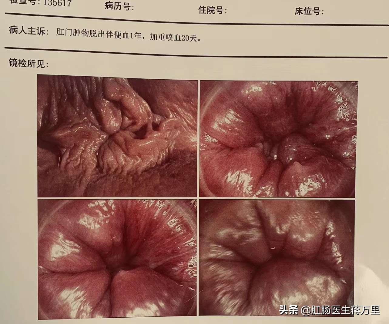 大量便血真实案例,大量便血的真实案例