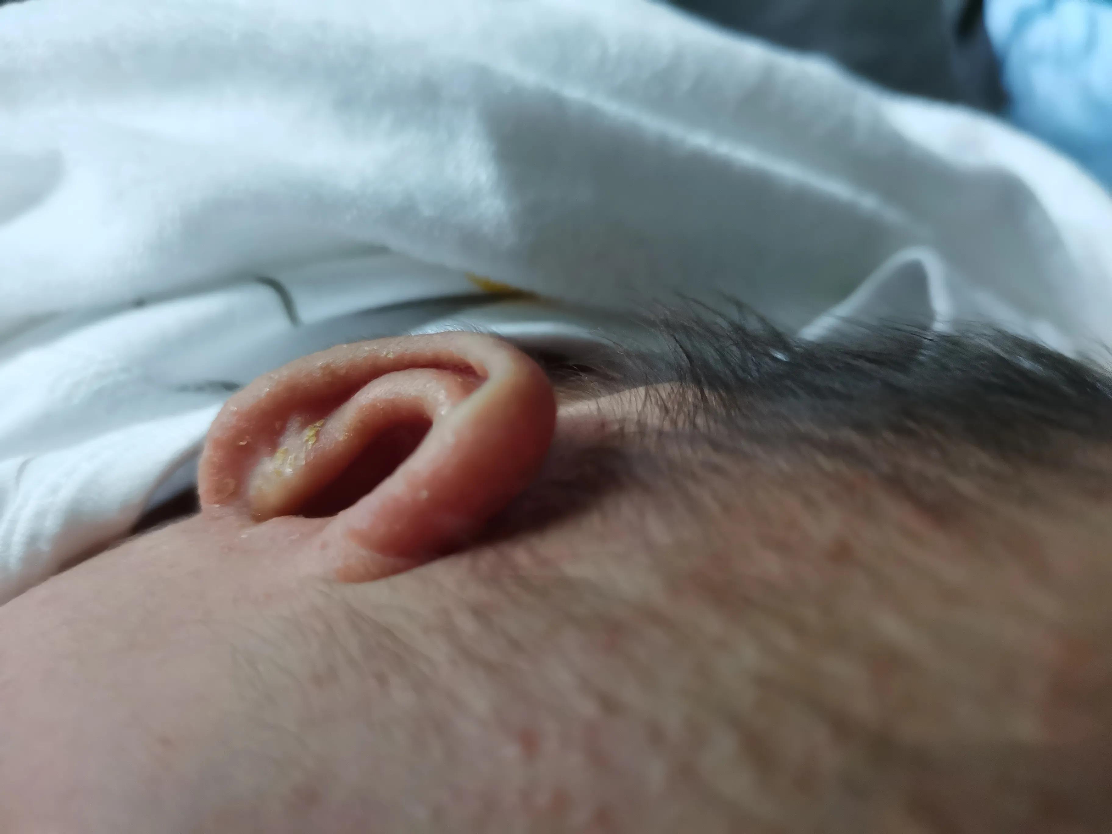 南方湿疹的最佳治疗方法,婴儿耳垂根部湿疹