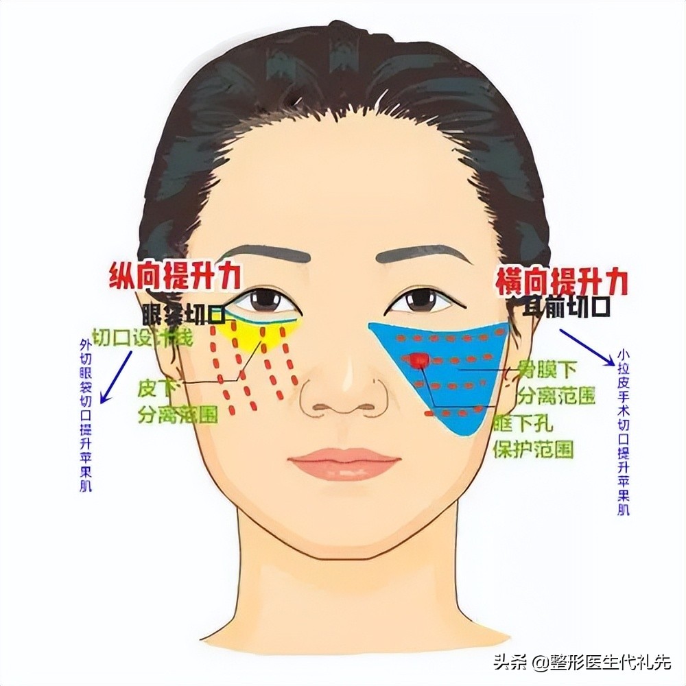 去法令纹现在最有效的方法是什么,去除法令纹的最有效的方法是什么