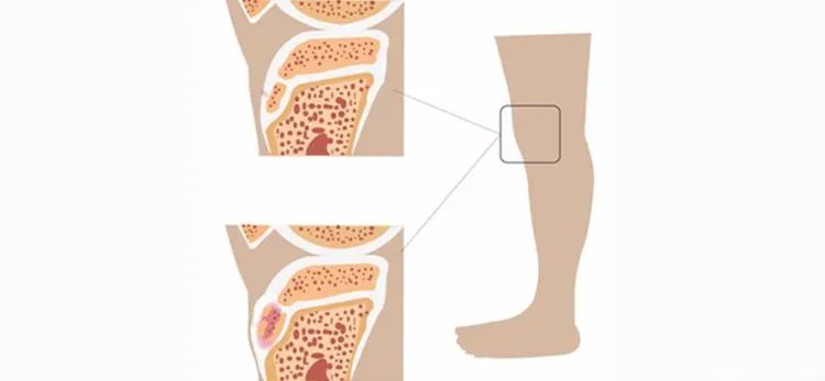 膝盖前面肿了一个包,孩子膝盖上长了一个疙瘩