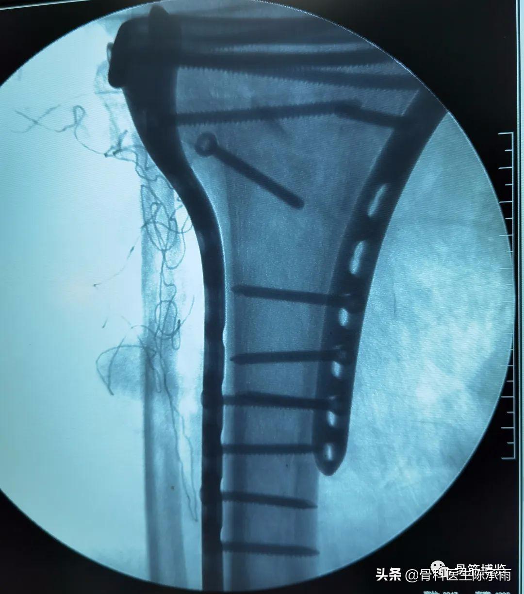 陈旧性腿骨骨折,陈旧性骨折