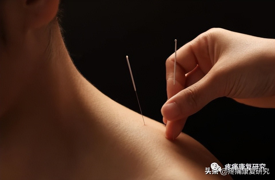 针灸止痛的原理图,针灸镇痛已被国际公认
