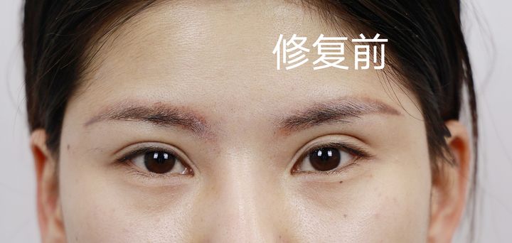 双眼皮线条很长可以提升眼尾吗,双眼皮眼尾太短怎么修复