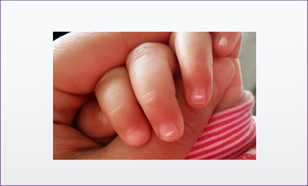 宝宝指甲有白斑是肚子有虫吗,一周半宝宝指甲上有白点怎么回事