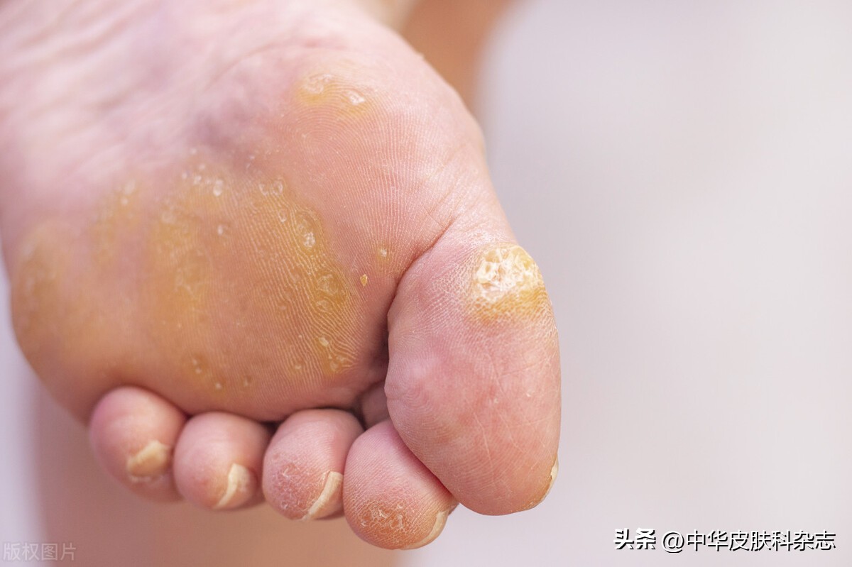 跖疣与鸡眼与胼胝的鉴别表格,鸡眼和跖疣还有胼胝的区别