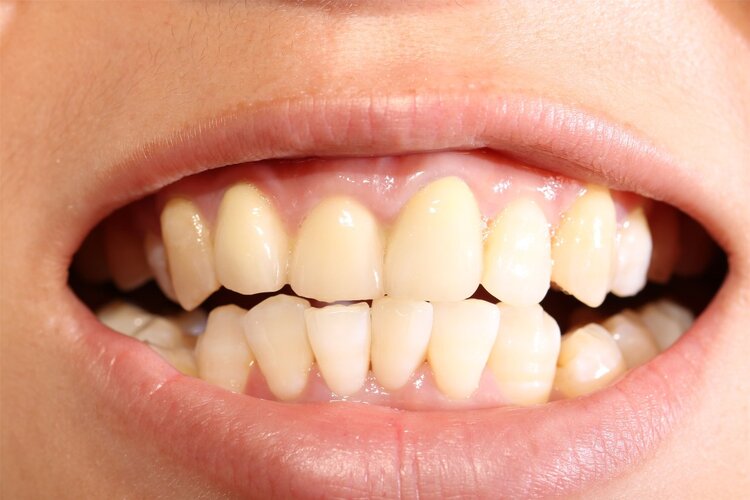 牙龈严重萎缩的解决办法,牙龈萎缩的原因及治疗方法