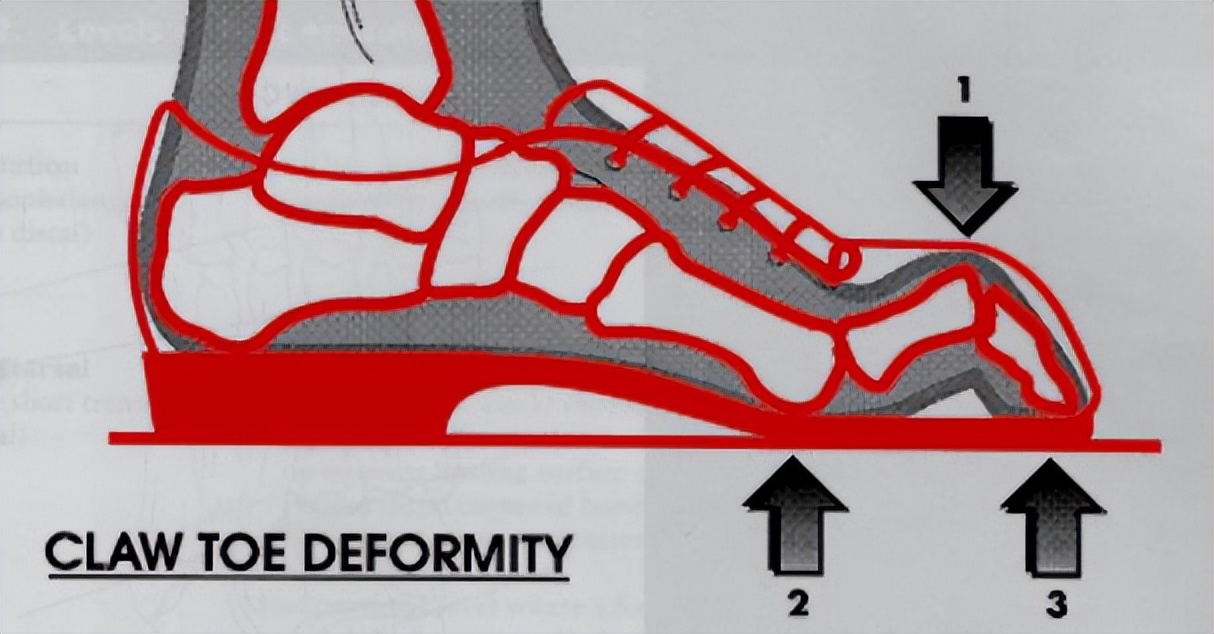 导致步态异常的常见原因,常见异常步态模式评定