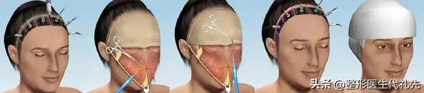 面部小切口提升悬吊术是小拉皮吗,面部提升拉皮分哪些部位
