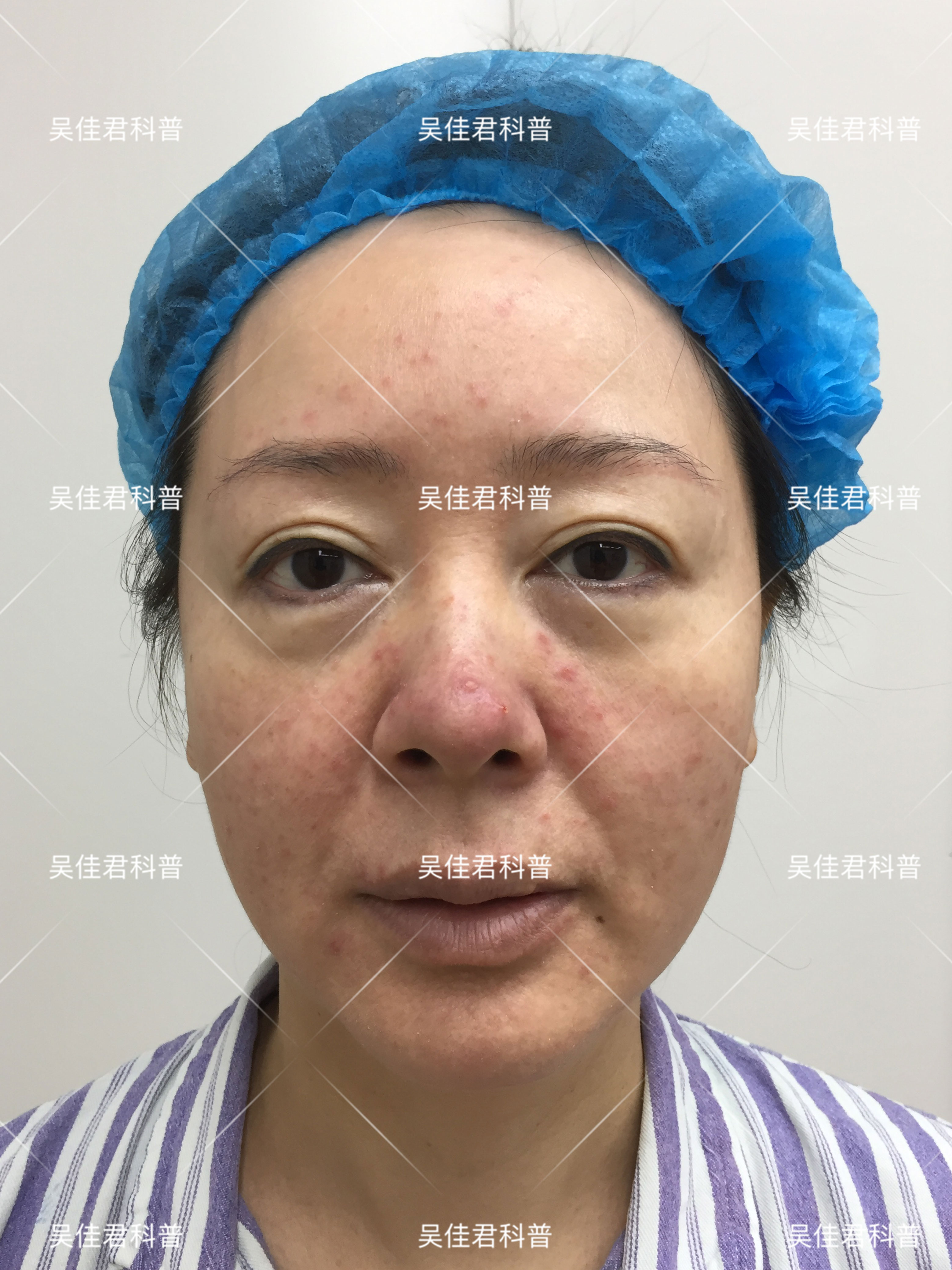 全脸皱纹拉皮手术对比,面部大拉皮恢复的真实感受