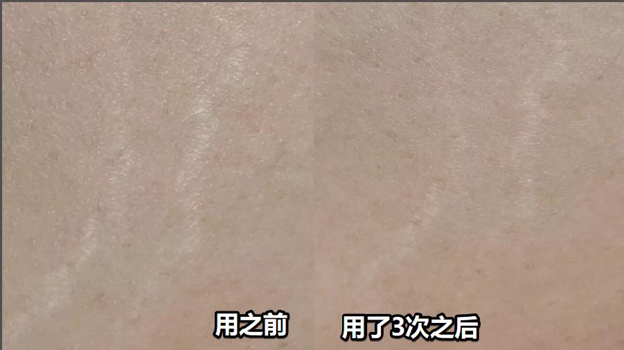 淡肥胖纹最简单有效的方法,用什么方法让肥胖纹彻底消失