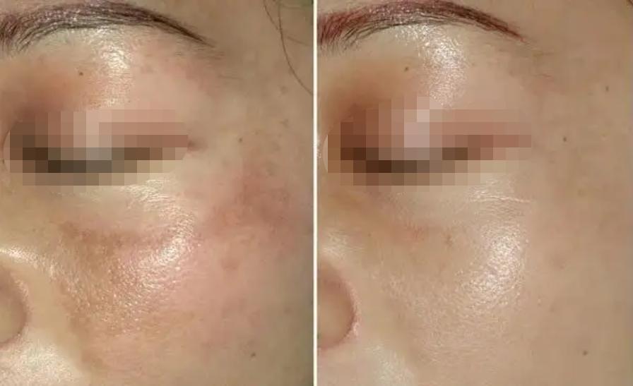 5个淡斑秘籍,淡斑最简单有效的方法白糖