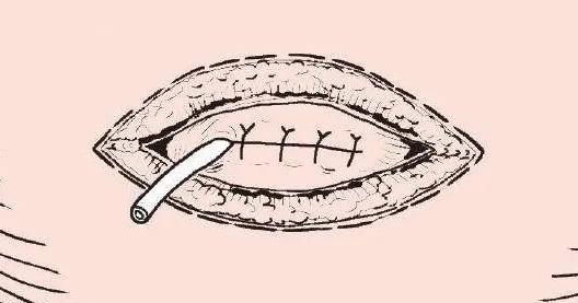 伤口缝合留疤还是不缝合留疤,可吸收的缝合线有疤痕吗