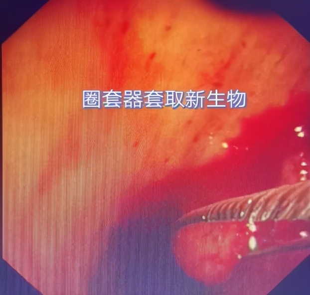 哈医大一院气管镜,哈医大群力呼吸内科