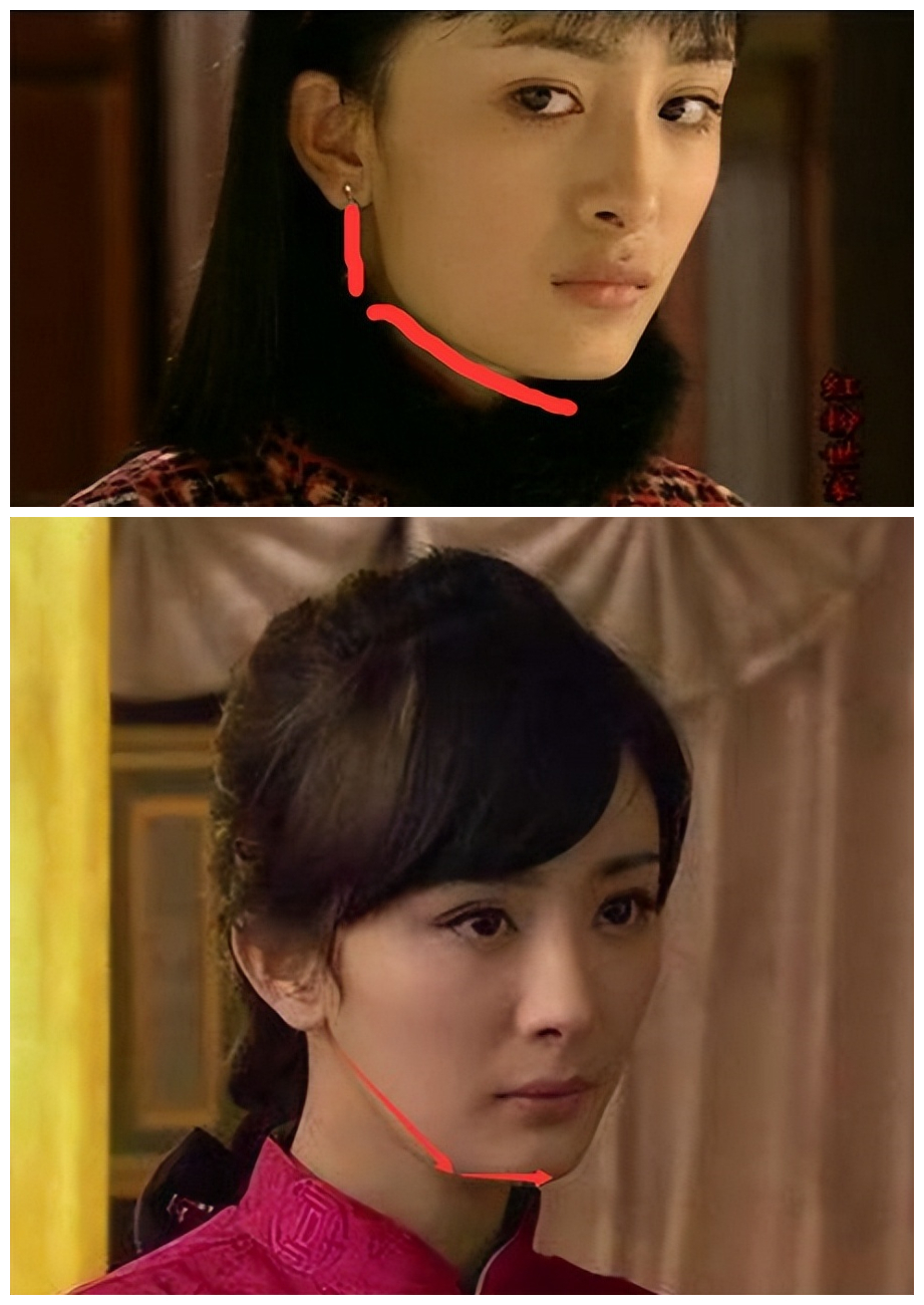 哪些明星整容后遗症越来越严重,整容明星后遗症对比图片