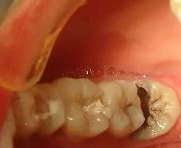 牙科缓解牙痛的方法,牙痛张不开嘴怎么解决