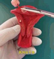 不同的子宫肌瘤都长啥样？看医生如何切除