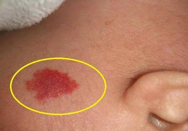 孩子身上长胎记，让她上学时被笑话，准妈妈孕期别太大意了