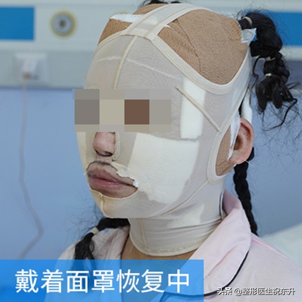 为什么第二次拉皮后法令纹更深了,拉皮手术后多久可以做法令纹填充