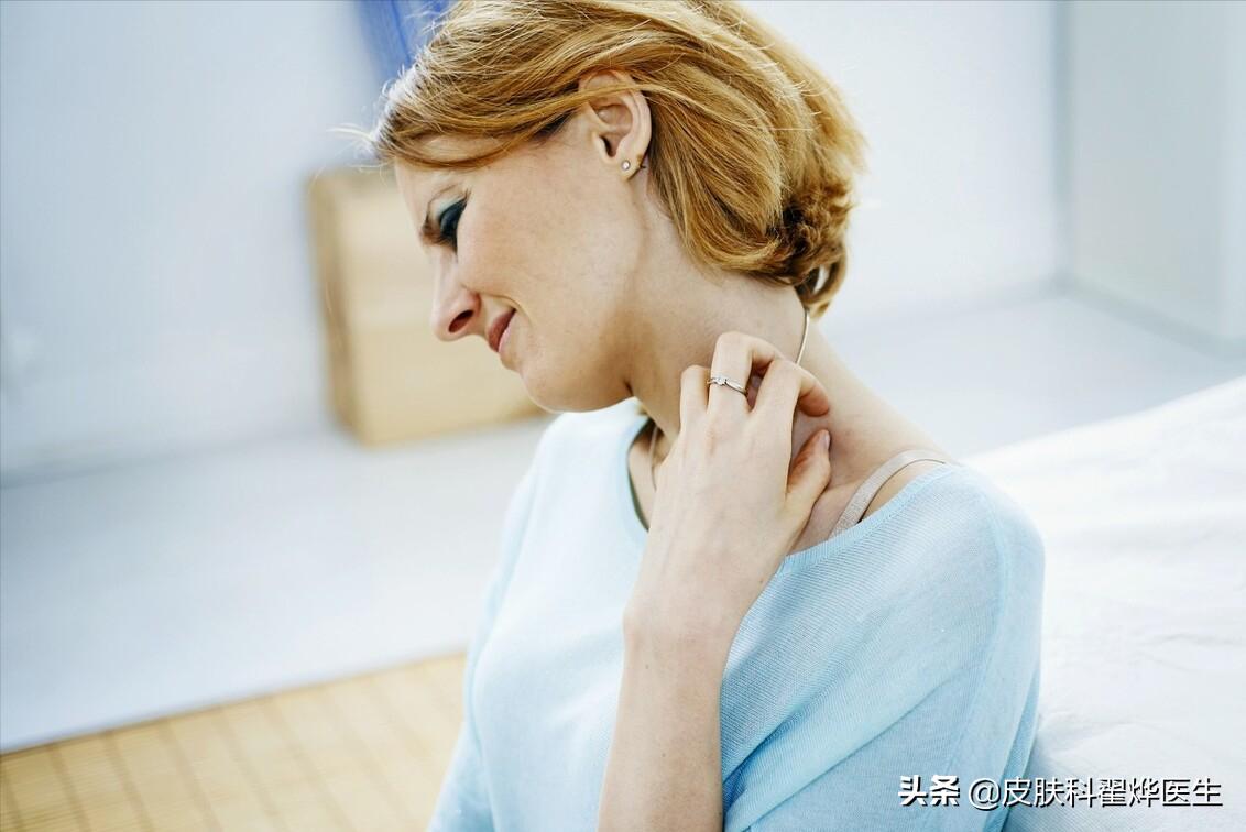 女性私部湿疹瘙痒怎么办,湿疹瘙痒反复发作怎么办