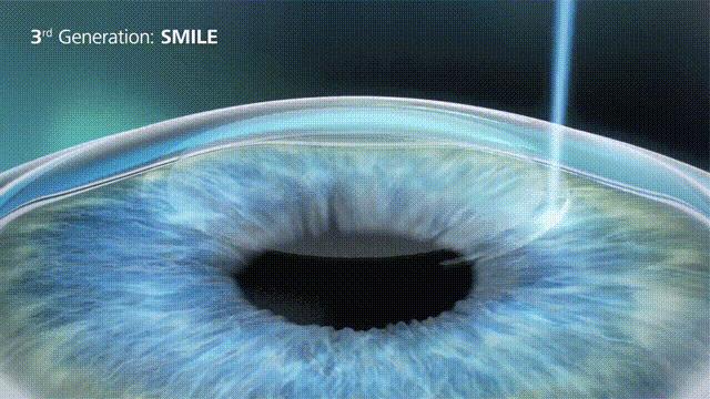 飞秒激光近视手术大概需要多少钱,近视矫正手术安全