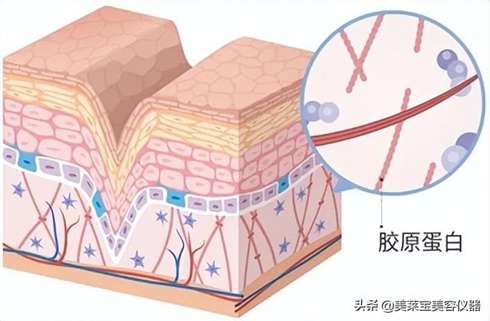 鱼尾纹最显老的一个部位,鸡爪纹和鱼尾纹哪个显老