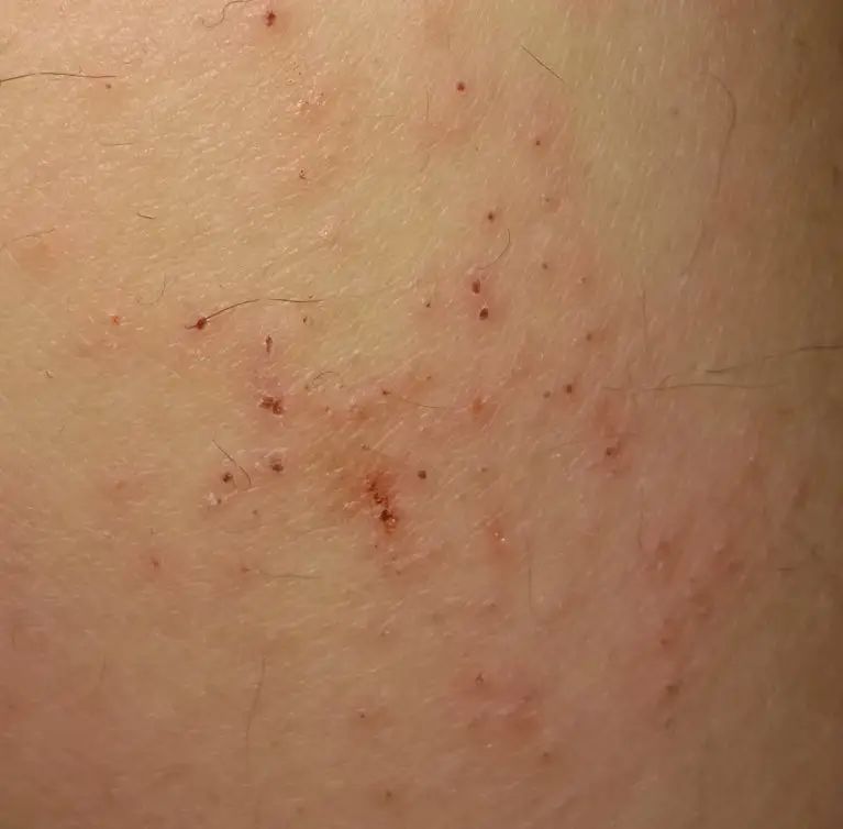 一到秋冬季双手就脱皮怎么治疗,一到春天手心就开始干燥脱皮